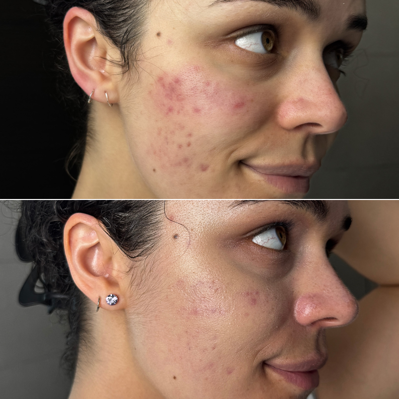 Red light therapy before & after: Pictures and results