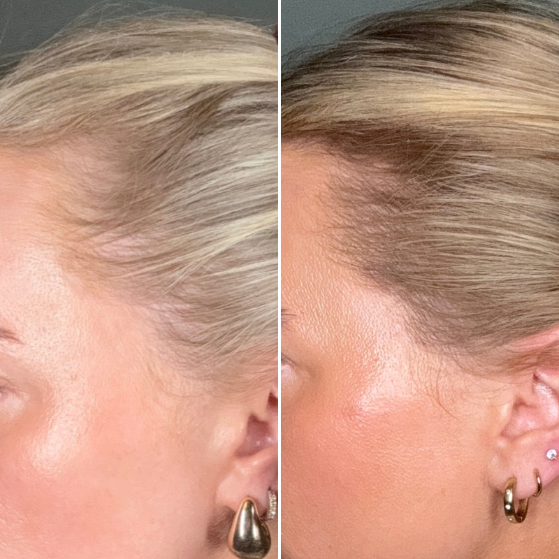 What are the main causes of female hair loss and is it reversible?