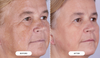 CurrentBody Skin RF Radio Frequency Skin Tightening Device