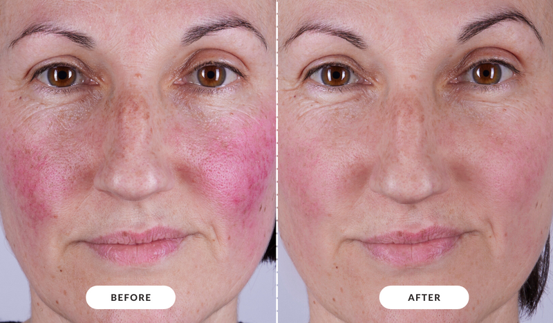 CurrentBody Skin LED Eye Perfector