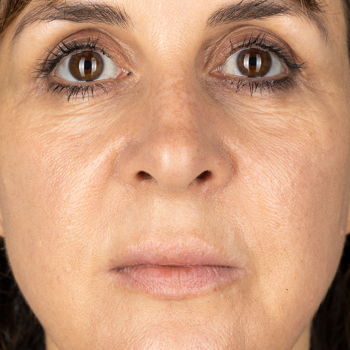 Radio Frequency Skin Tightening Device | CurrentBody Skin