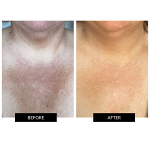 Currentbody Skin Neck and Dec & Neck and Dec Hydrogels x5