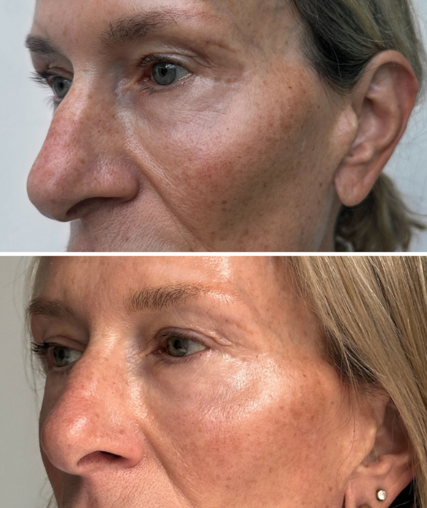 RF Skin Tightening | Radio Frequency Facial Device | CurrentBody RF Skin Tightening | Radio Frequency Facial Device | CurrentBody