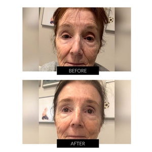 LYMA Laser (Blue) System Starter Kit & Free CurrentBody Skin Skincare