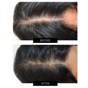 CapillusUltra Laser Cap for Hair Regrowth