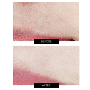JOVS Venus Pro Skin Rejuvenation and IPL Hair Removal Device