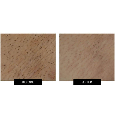 SmoothSkin Bare+ Ultrafast IPL Hair Removal Device