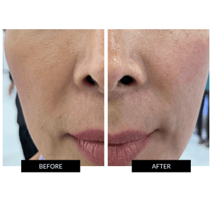 La Luer Mira Facial Treatment System
