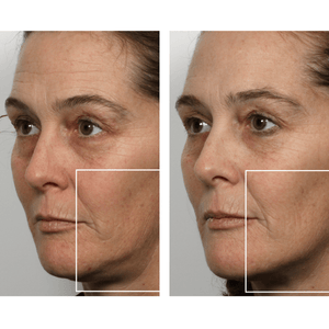 Women's jowls before and after using nuFACE mini