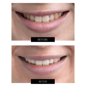 CurrentBody Skin Teeth Whitening Extended Kit