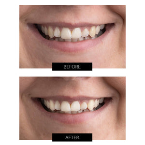 Currentbody Skin Teeth Whitening Gel Refill Syringes 5ml